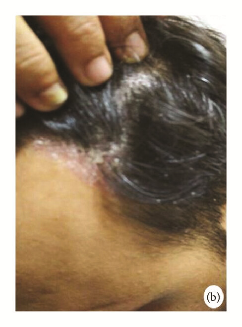 骨髓間充質干細胞 治療前，患者頭皮上出現大量紅斑，并附著銀色鱗片（b）。