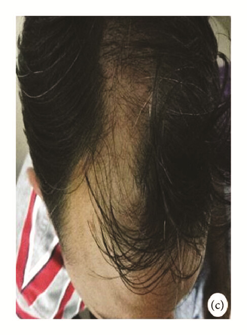 局部應用骨髓間充質干細胞一個月后，銀屑病消退，炎性紅斑完全清除（c）。