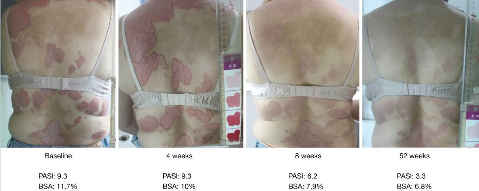 受試者治療前后的代表性皮膚圖像 受試者治療前后的代表性皮膚圖像