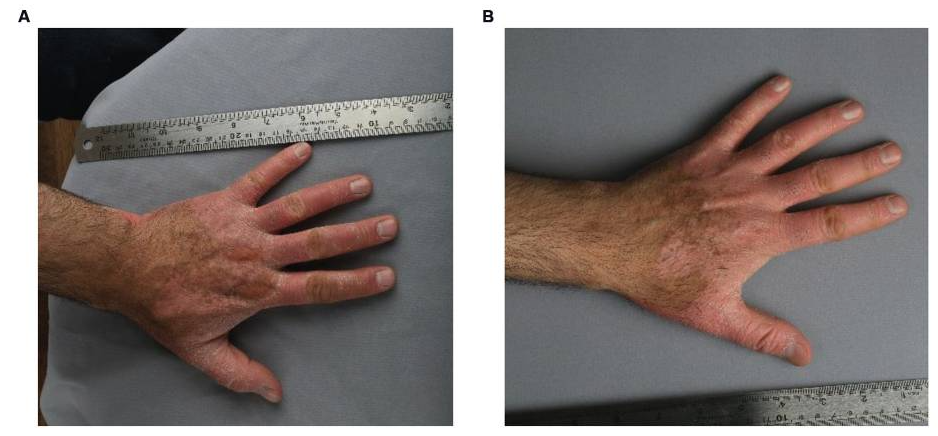 患者3細胞移植6個月后,注射部位的紅斑、脫屑和厚度明顯減少。皮膚厚度從2.1毫米減少到1.7毫米,與手部健康部位相似。該患者報告生活質量有所提高。PASI評分在注射細胞后從4.7變為4.3。 患者3細胞移植6個月后,注射部位的紅斑、脫屑和厚度明顯減少。皮膚厚度從2.1毫米減少到1.7毫米,與手部健康部位相似。該患者報告生活質量有所提高。PASI評分在注射細胞后從4.7變為4.3。
