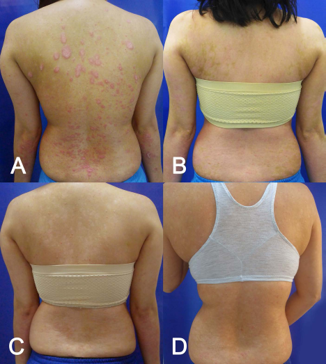 (圖2A）基線（細(xì)胞移植前)；(圖2B）首次輸注后 30 天；(圖C2) 121 天后；(圖2D）231 天后。