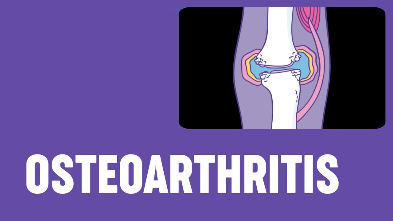 5項研究171例患者,評估干細(xì)胞治療骨關(guān)節(jié)炎的安全性和有效性 5項研究171例患者,評估干細(xì)胞治療骨關(guān)節(jié)炎的安全性和有效性