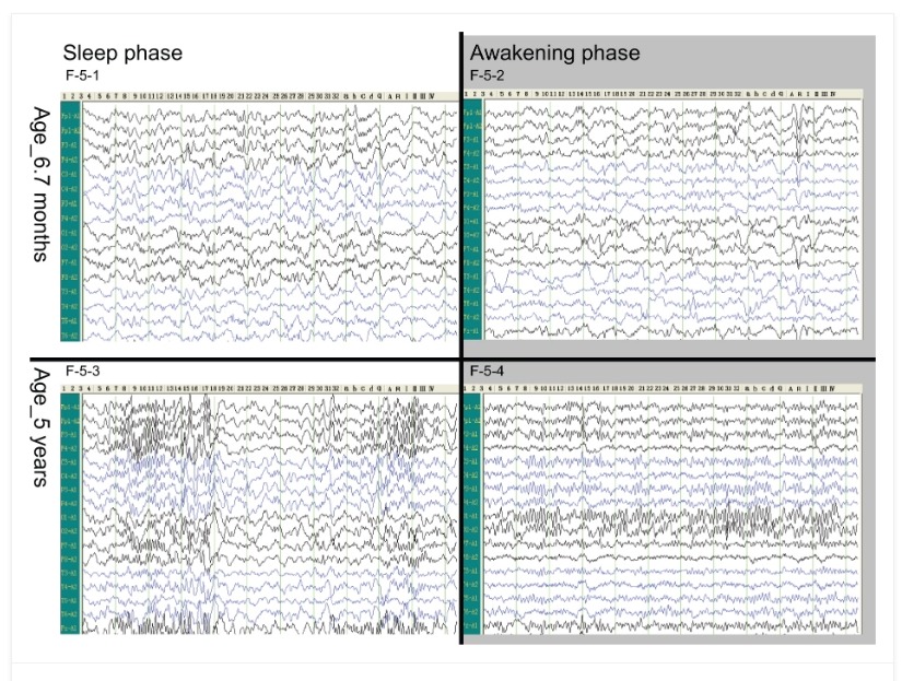 圖5.腦電圖。 圖5.腦電圖。