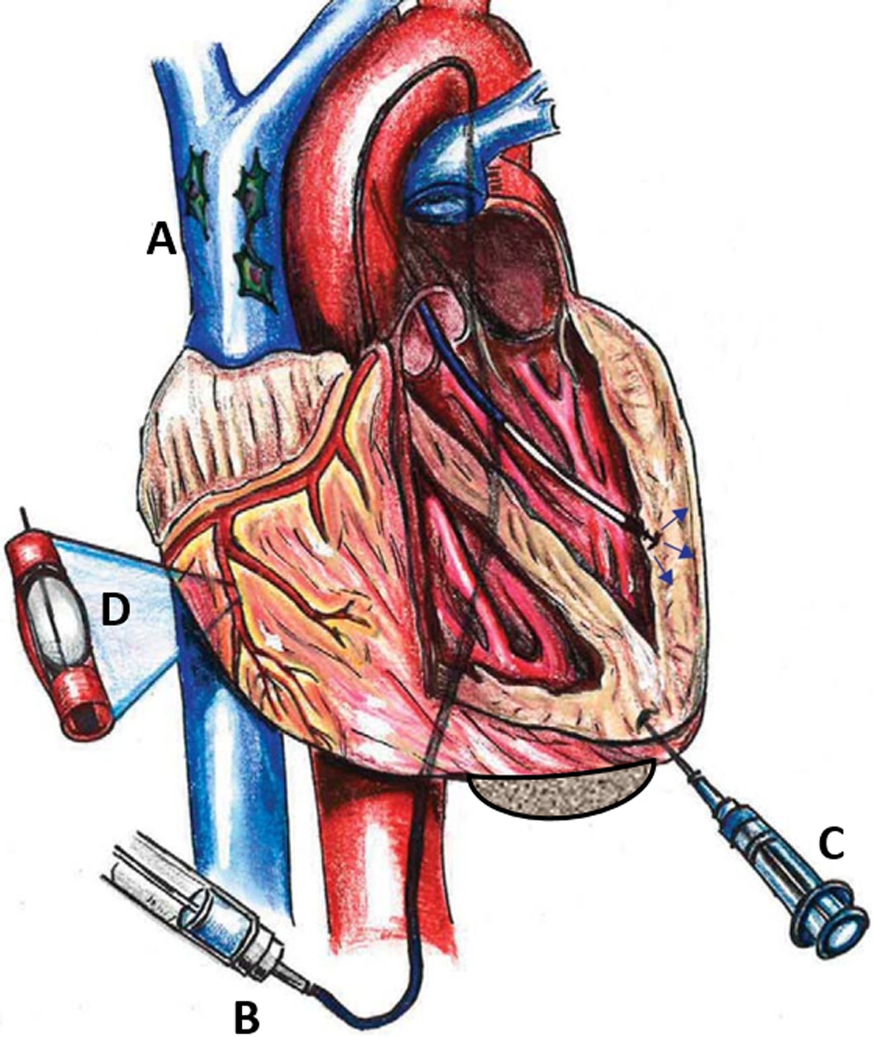 圖1：MSC通過系統(tǒng) (Sys) 和局部 (Loc) 途徑進(jìn)入心臟。