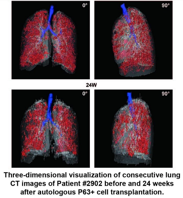 患者#2902在自體P63+細(xì)胞移植前后24周連續(xù)肺部CT圖像的三維可視化。 患者#2902在自體P63+細(xì)胞移植前后24周連續(xù)肺部CT圖像的三維可視化。