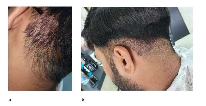 圖2.患者枕部頭皮銀屑病治療后圖像2周(a)和4周(b)頭皮銀屑病治療后鱗屑和斑塊減少的隨訪圖像。 圖2.患者枕部頭皮銀屑病治療后圖像2周(a)和4周(b)頭皮銀屑病治療后鱗屑和斑塊減少的隨訪圖像。