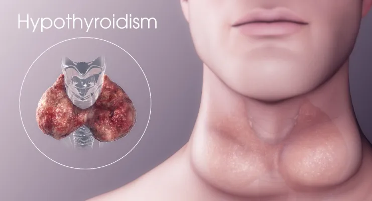 什么是甲狀腺功能減退癥 什么是甲狀腺功能減退癥