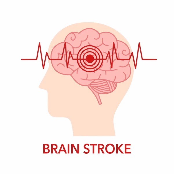 直擊腦卒中:神經干細胞移植的治療方法有哪些? 直擊腦卒中:神經干細胞移植的治療方法有哪些?