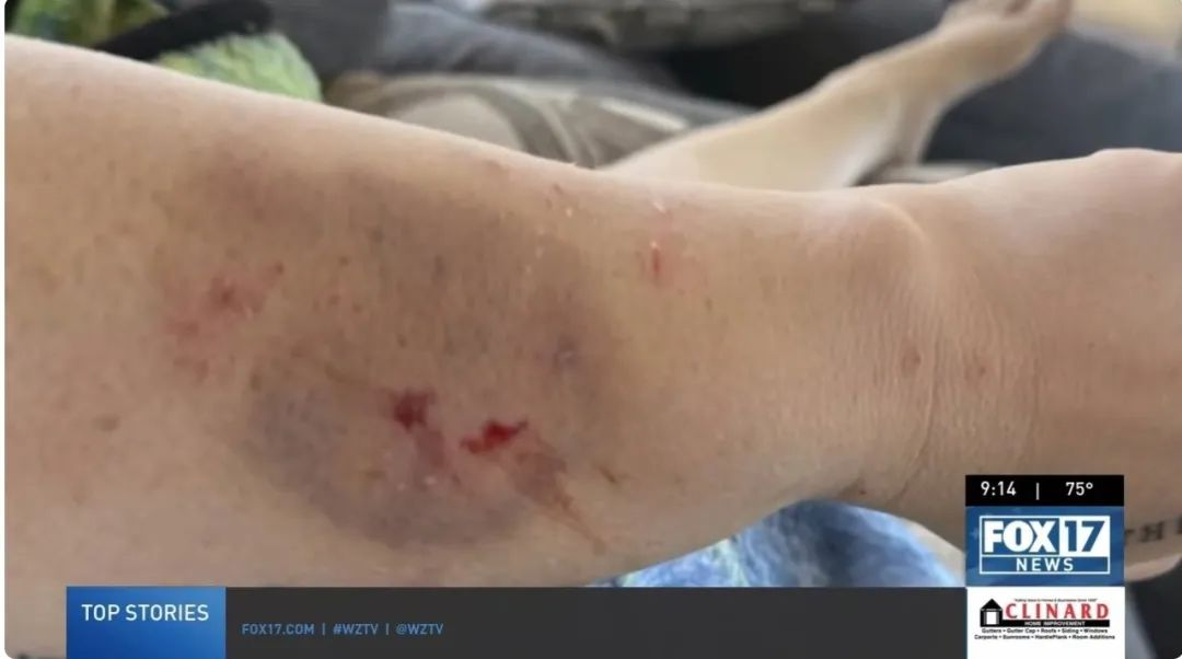 在接受干細(xì)胞治療前表現(xiàn)出嚴(yán)重的自閉癥癥狀,甚至曾咬傷母親安吉拉,留下了永久的疤痕 在接受干細(xì)胞治療前表現(xiàn)出嚴(yán)重的自閉癥癥狀,甚至曾咬傷母親安吉拉,留下了永久的疤痕