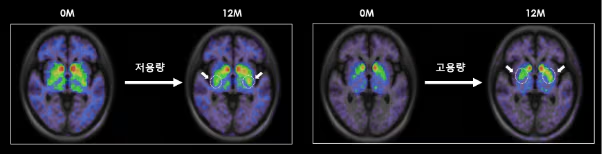 
低劑量和高劑量TED-A9植入一年后的腦成像。