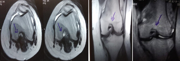 治療前 MRI 顯示內側和外側半月板后角 III 級撕裂。