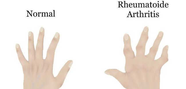 干細(xì)胞治療類風(fēng)濕關(guān)節(jié)炎:如何實(shí)現(xiàn)從短期關(guān)節(jié)功能改善到長(zhǎng)期的生活質(zhì)量提升? 干細(xì)胞治療類風(fēng)濕關(guān)節(jié)炎:如何實(shí)現(xiàn)從短期關(guān)節(jié)功能改善到長(zhǎng)期的生活質(zhì)量提升?