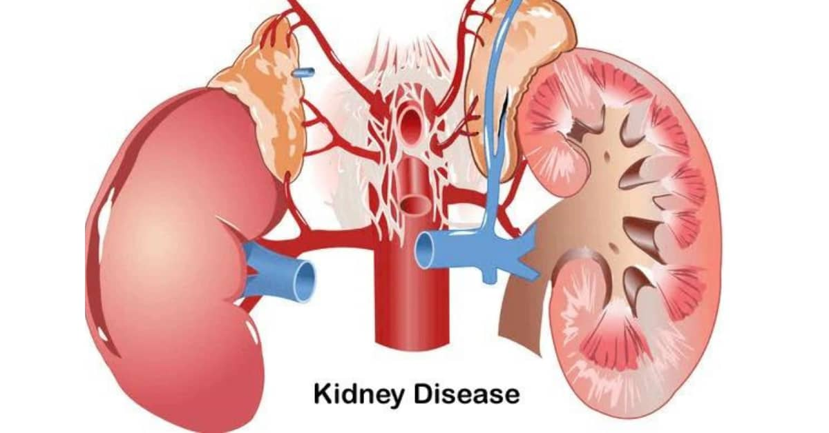 干細胞治療腎病：靜脈、動脈、皮質注射哪種更安全