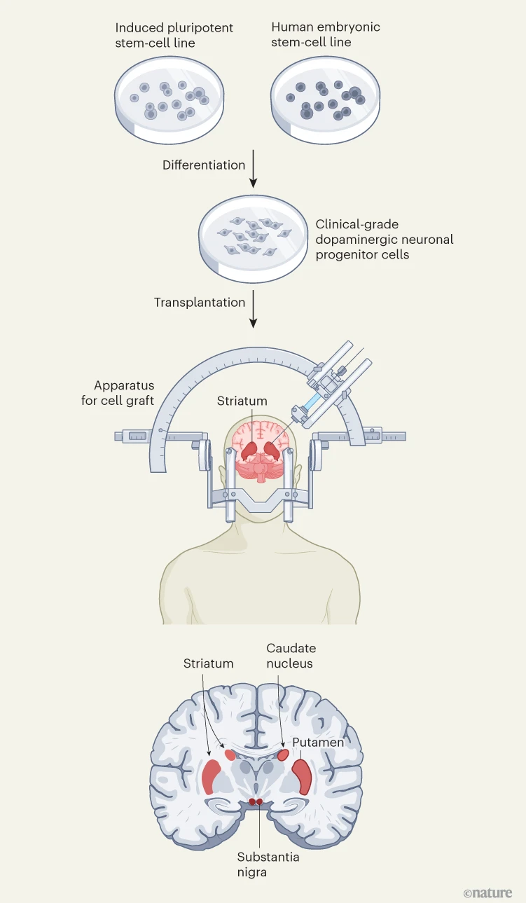 圖1：帕金森病的干細(xì)胞療法。