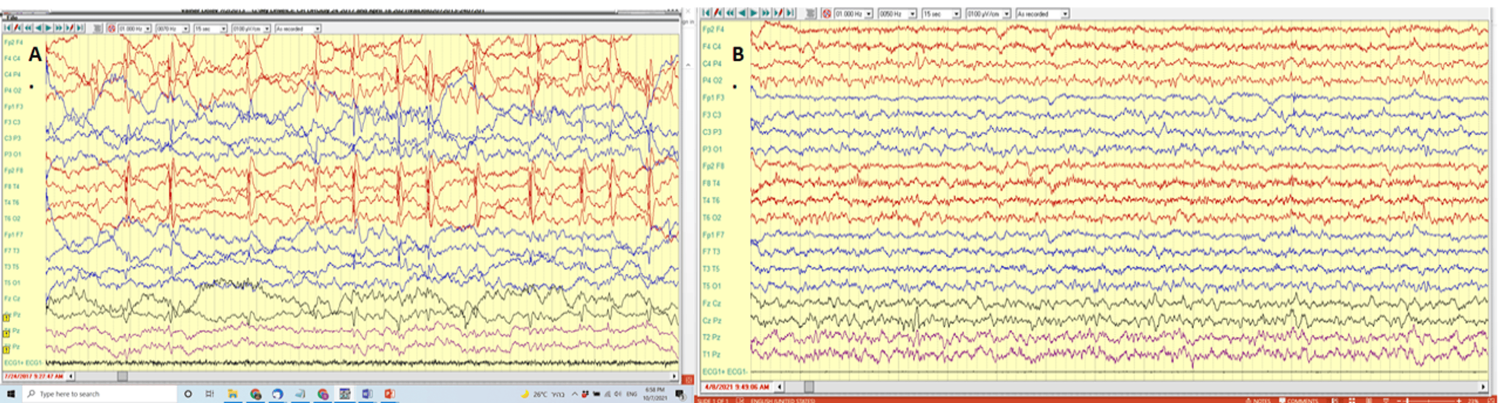 圖1:alloMSCT#1前后的腦電圖結(jié)果 圖1:alloMSCT#1前后的腦電圖結(jié)果