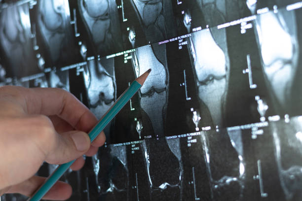 4種細胞療法運用免疫調節(jié)和再生機制為治療骨科疾病開辟了新方向 4種細胞療法運用免疫調節(jié)和再生機制為治療骨科疾病開辟了新方向