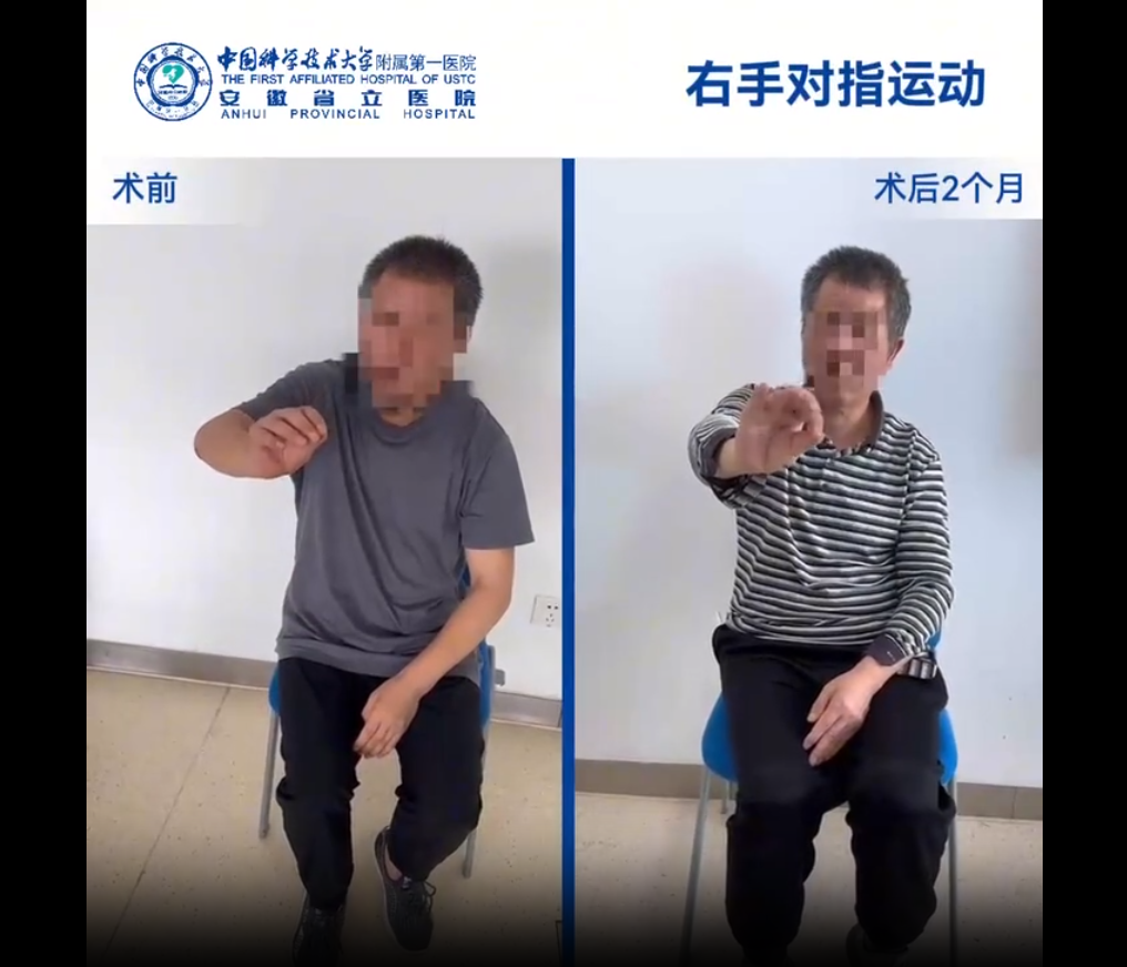 國(guó)內(nèi)誘導(dǎo)多能干細(xì)胞療法新突破：首例早發(fā)型帕金森病成功給藥，當(dāng)天即可行走