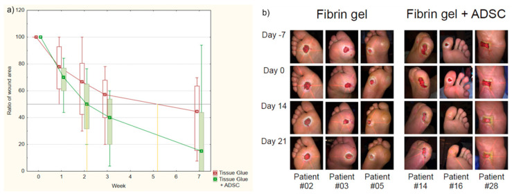 圖1:纖維蛋白凝膠組和AASC組患者治療進展對比。 圖1:纖維蛋白凝膠組和AASC組患者治療進展對比。