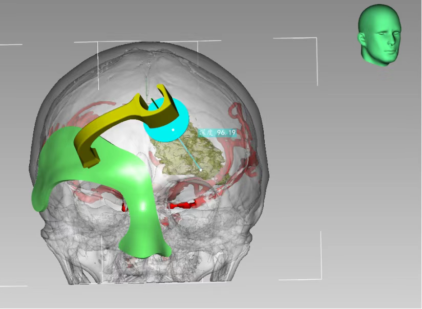 3D打印技術定位下腦內血腫穿刺術 3D打印技術定位下腦內血腫穿刺術