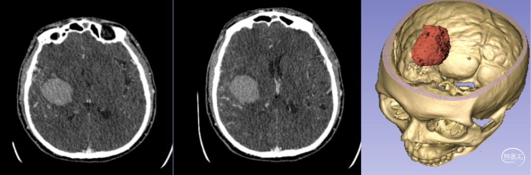 神經外科手術機器人輔助下腦內血腫穿刺術 神經外科手術機器人輔助下腦內血腫穿刺術