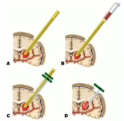神經內鏡輔助下腦內血腫清除術示意圖 神經內鏡輔助下腦內血腫清除術示意圖