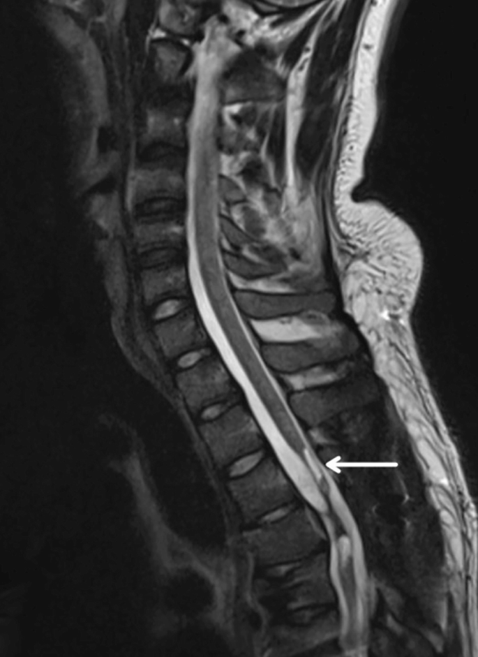 圖2：X射線(xiàn)圖像顯示慢性期脊髓損傷，通常以囊腫形成為特征，如白色箭頭所示