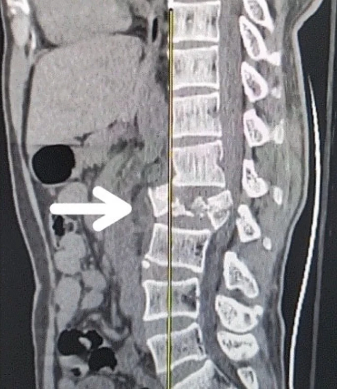 圖1：X射線(xiàn)圖像顯示脊髓損傷，椎骨骨折和移位，如白色箭頭所示