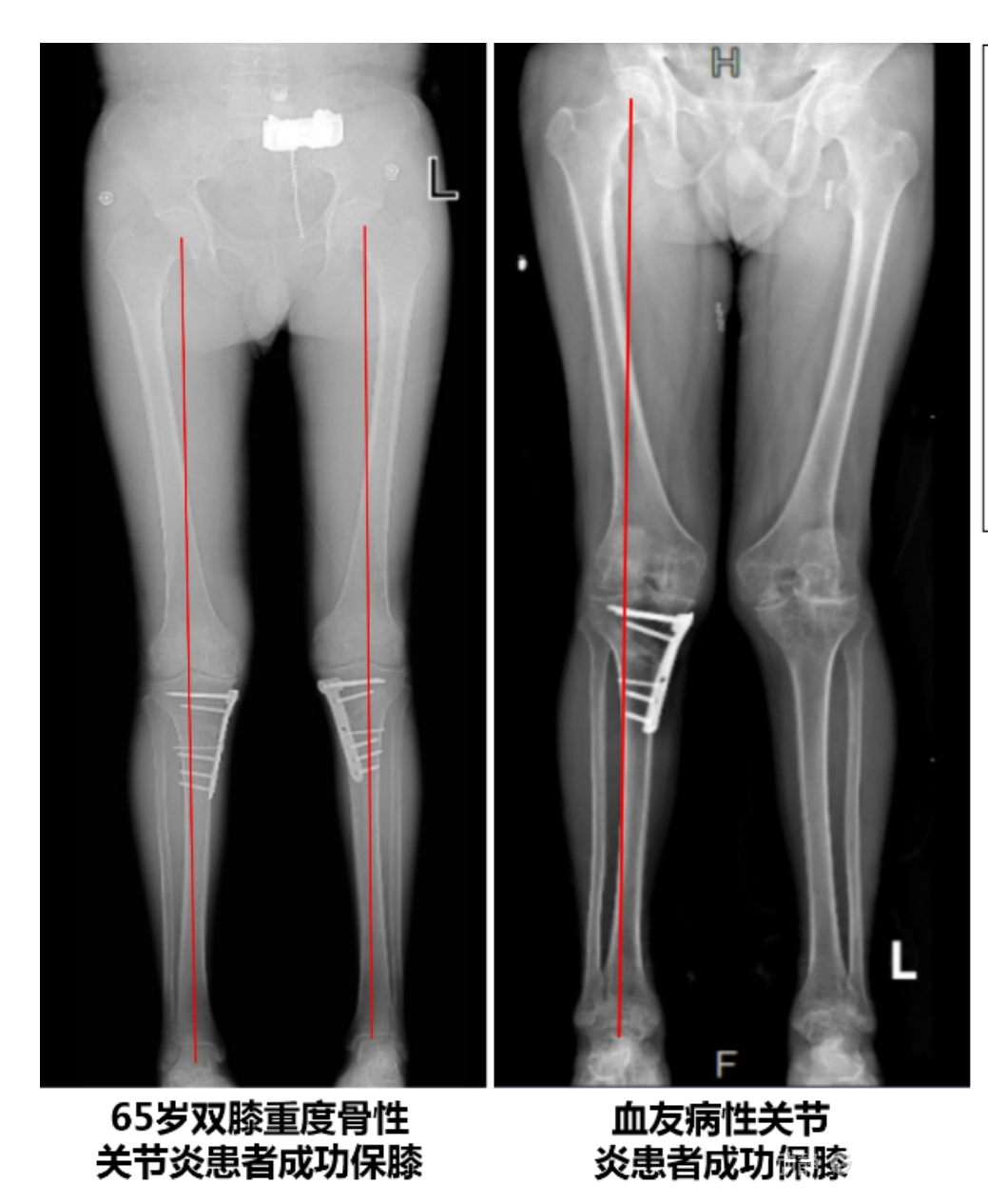 APTT-HTO脛骨高位截骨術 APTT-HTO脛骨高位截骨術
