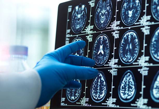 神經干細胞移植十大常見問題解答：從原理到術后護理全知道