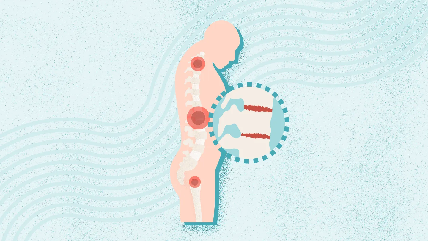 2025年干細胞治療強直性脊柱炎最新臨床進展（截至12月）