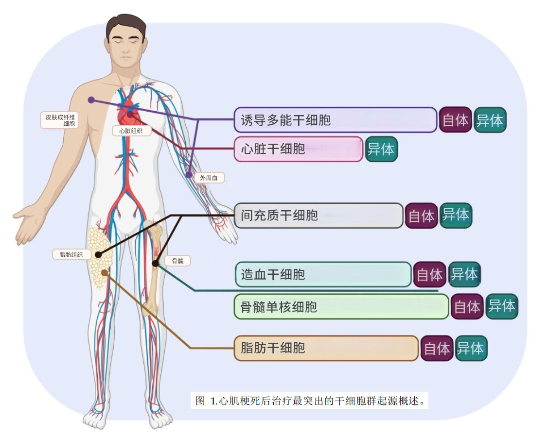 干細胞治療心梗 干細胞治療心梗