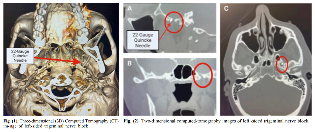 三叉神經痛臨床試驗