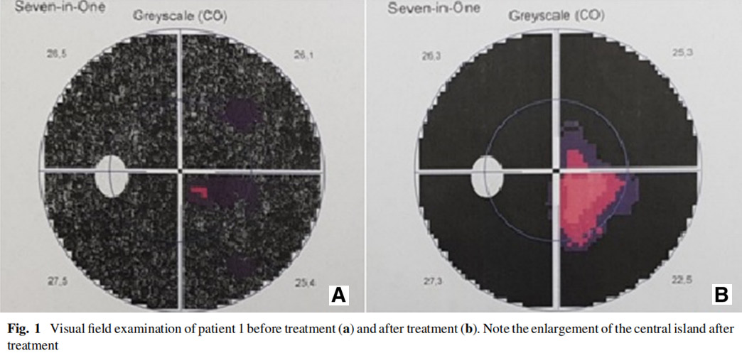 視神經萎縮臨床試驗