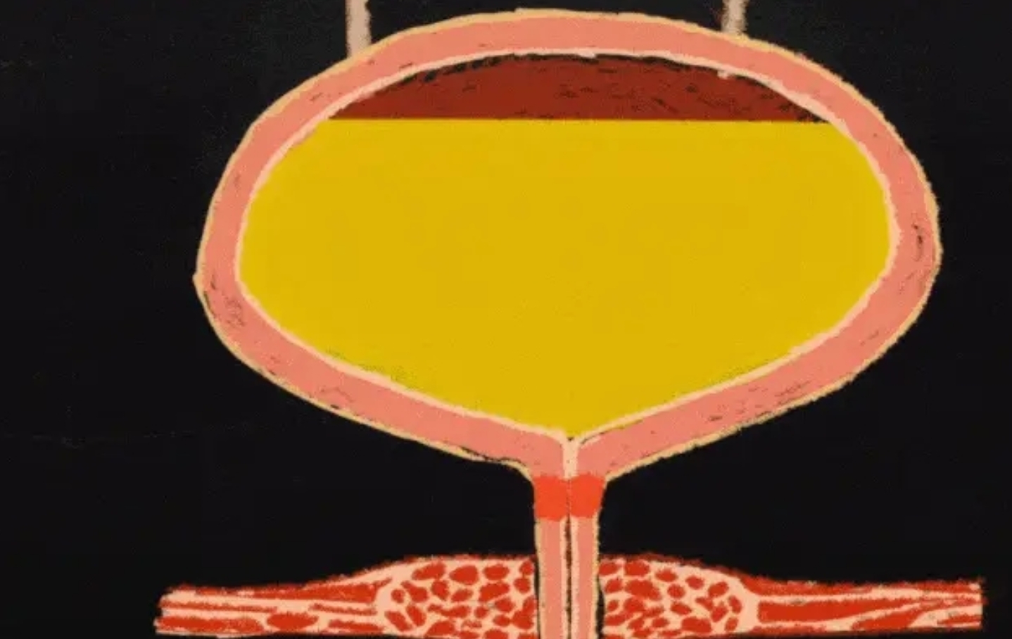 神經源性膀胱 神經源性膀胱