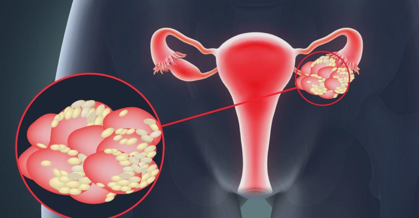 多囊卵巢綜合征 多囊卵巢綜合征