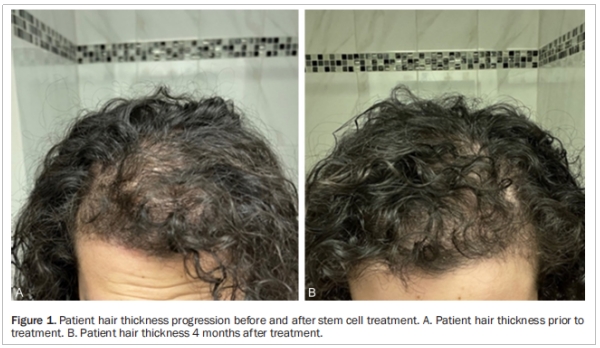 多囊卵巢綜合征臨床試驗 多囊卵巢綜合征臨床試驗