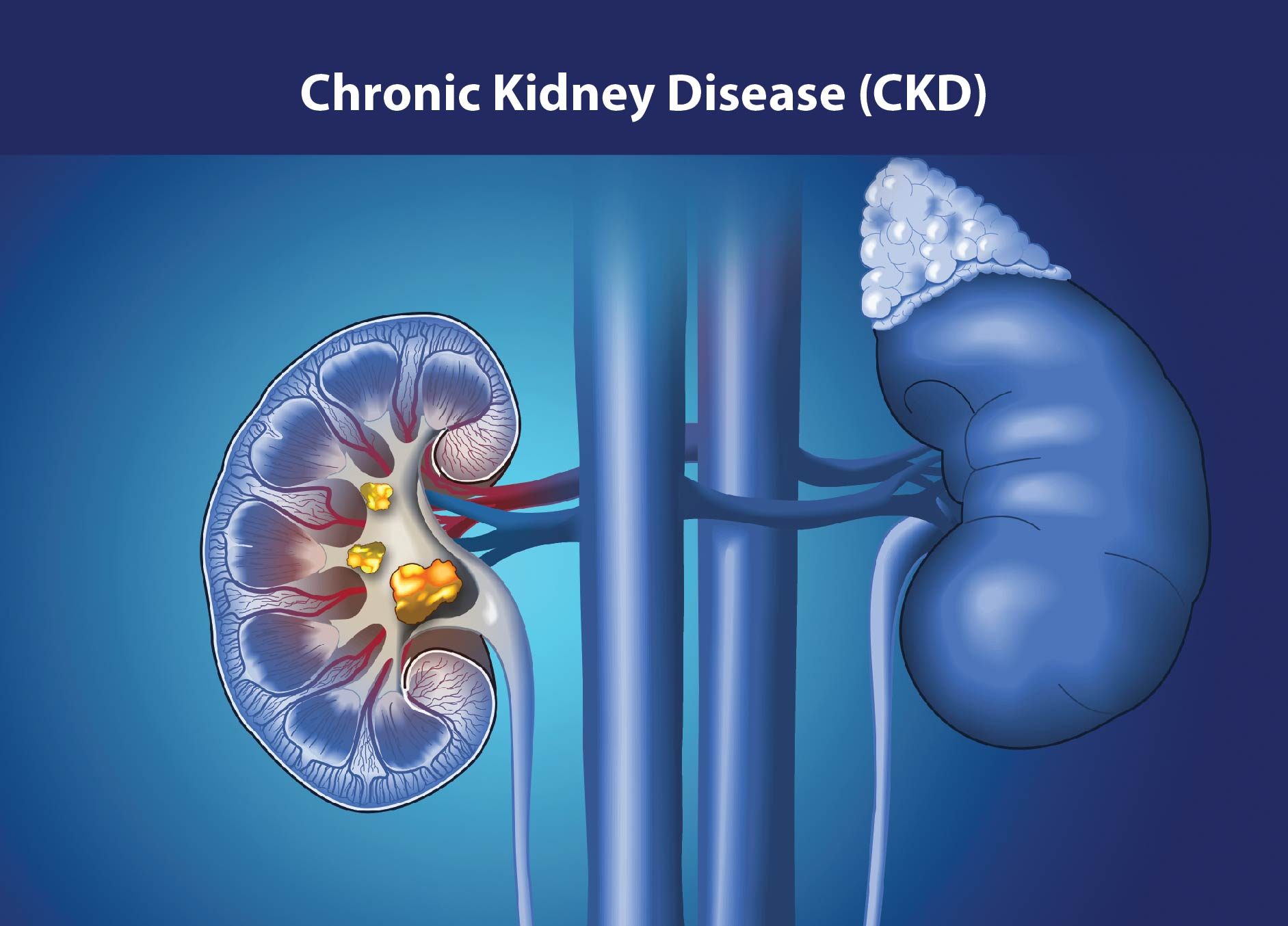 慢性腎病治療新策略：間充質干細胞如何修復腎功能、延緩疾病進展？