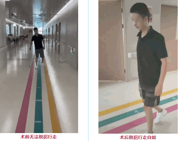 干細胞治療脊髓損傷患者 干細胞治療脊髓損傷患者