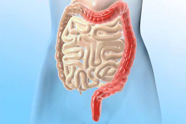 潰瘍性結(jié)腸炎新希望：干細(xì)胞移植2個月緩解率達(dá)7成，4成患者實現(xiàn)粘膜愈合