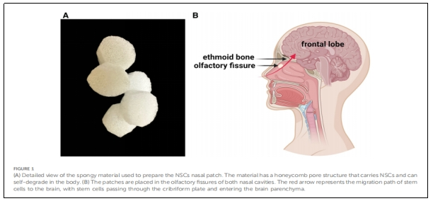 圖1:用于制備NSCs鼻貼片的海綿狀材料的詳細(xì)視圖。 圖1:用于制備NSCs鼻貼片的海綿狀材料的詳細(xì)視圖。