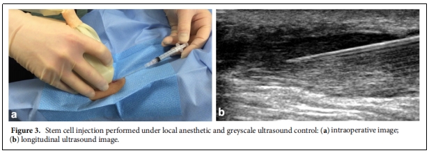 圖3.在局部麻醉和灰階超聲控制下進(jìn)行的干細(xì)胞注射