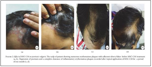 圖2：MSC-CM對尋常型銀屑病的影響。