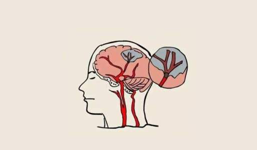 中風(fēng)后的腦損傷,真的能被干細(xì)胞療法逆轉(zhuǎn)嗎? 中風(fēng)后的腦損傷,真的能被干細(xì)胞療法逆轉(zhuǎn)嗎?