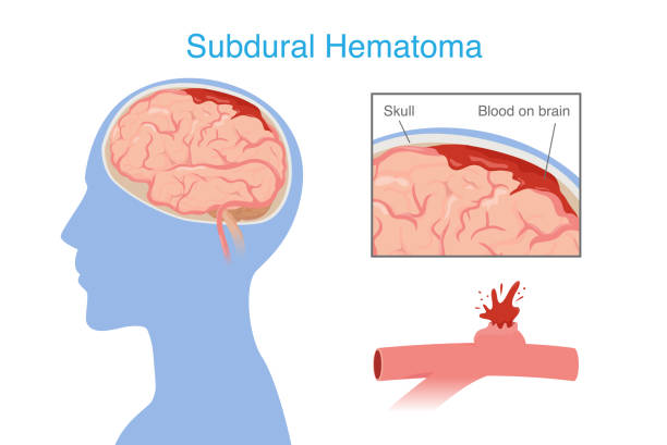 神經(jīng)干細(xì)胞移植治療腦出血的系統(tǒng)評(píng)價(jià):NSC來源、輸送途徑、治療機(jī)制和早期臨床試驗(yàn) 神經(jīng)干細(xì)胞移植治療腦出血的系統(tǒng)評(píng)價(jià):NSC來源、輸送途徑、治療機(jī)制和早期臨床試驗(yàn)