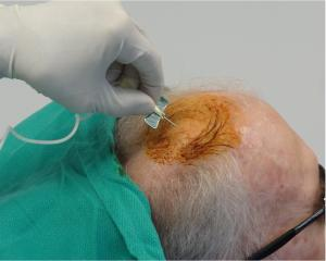 干細胞注射到大腦過程。 干細胞注射到大腦過程。