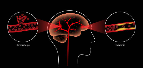 臍帶干細胞靜脈注射治療腦卒中?Ⅰ期人體研究結果公布:臨床顯示安全有效 臍帶干細胞靜脈注射治療腦卒中?Ⅰ期人體研究結果公布:臨床顯示安全有效