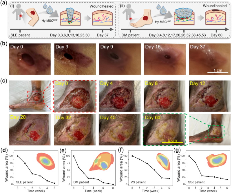 圖:MSC-HGF負載水凝膠在臨床上治愈人類RW傷口。